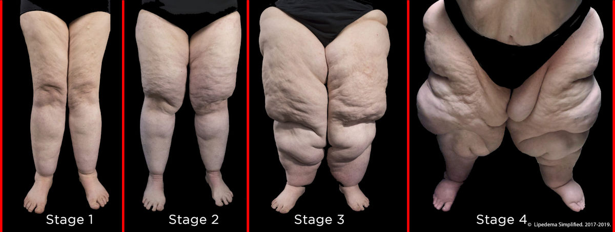Stages of Lipoedema